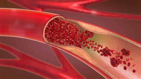 Do You Have Blood Clots In Your Legs It May Be Caused By Vein Disease