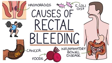Understanding Anal Bleeding Causes And Treatment Ask The Nurse Expert