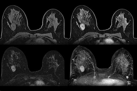 New Tech Emerges To Detect Breast Cancer The Iowa Clinic