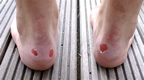 Blisterswhy Do They Occur And Prevention Total Care Podiatry