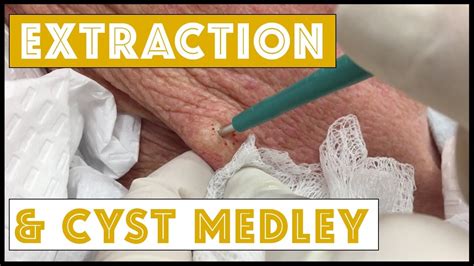Cyst Extraction On Neck By Health Youtube