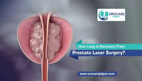 How Long Is Recovery From Prostate Laser Surgery