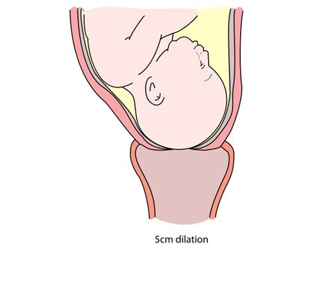 Cervical Dilation