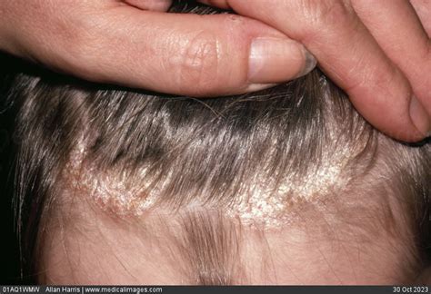 Stock Image Dermatology Scalp Psoriasis White Dry Flaky Skin Along The