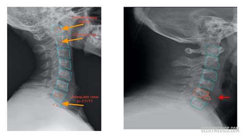 Cervical Spine X Ray Interpretation Osce Guide Geeky Medics