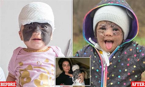 Florida Girl Two Has Her Batman Mask Birthmark Removed After Pioneering Surgery In Russia