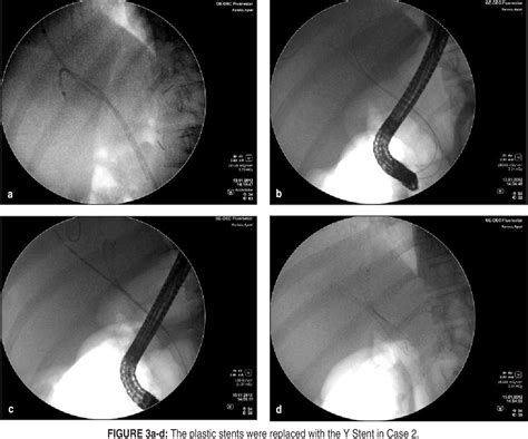 Figure From Endoscopic Bilateral Metallic Stenting For Malignant