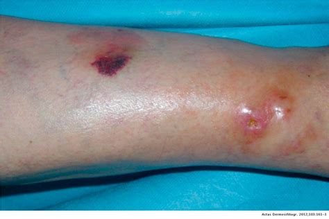 Localized Primary Cutaneous Nodular Amyloidosis In A Patient With