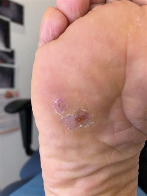 Plantar Warts Verrucae How To Finally Get Rid Of Those Painful Lumps On The Bottom Of Your Feet