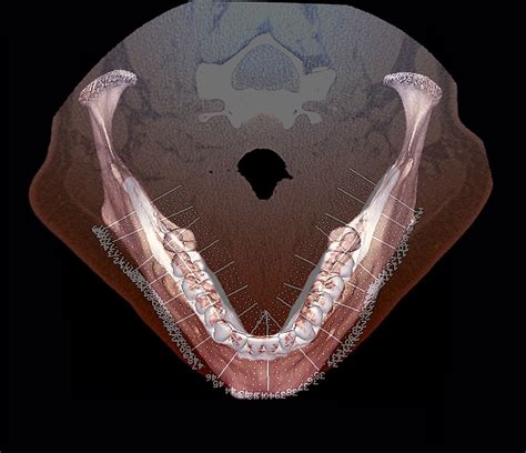 Lower Jaw And Teeth 3d Ct Scan Bild Kaufen 12303399 Science Photo