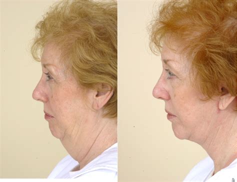 Neck Lift Without The Facelift Plastic Surgery Blog Buildmybod
