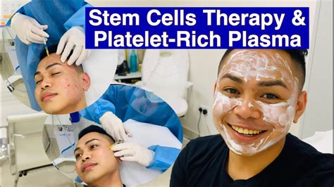 Goodbye Acne Scars Stem Cells Therapy And Platelet Rich Plasma Youtube
