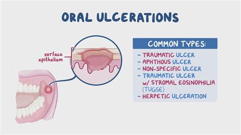 Western University Oral Ulcers Osmosis Video Library