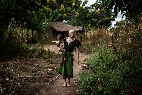 Albinos In Malawi Being Hunted For Their Body Parts For Witchcraft On