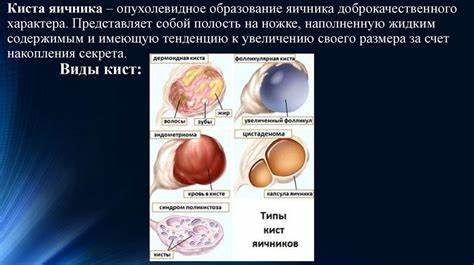 Диета киста яичника Диета киста яичника