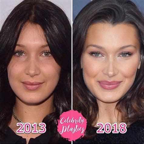 bella hadid plastic surgery before and after who magazine rhinoplasty nose jobs face