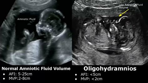 Amniotic Fluid Volume Ultrasound Normal Vs Abnormal Oligohydramnios