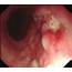 Upper Gastrointestinal Endoscopy Revealing A Big Esophageal Ulcer With 