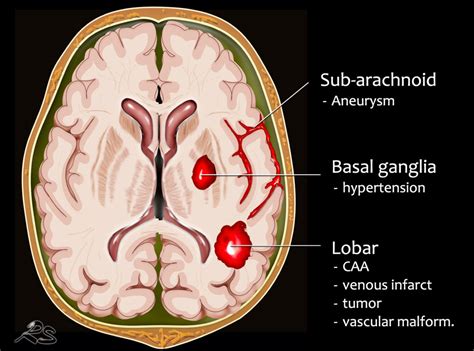 The Radiology Assistant Nontraumatic Intracranial Hemorrhage