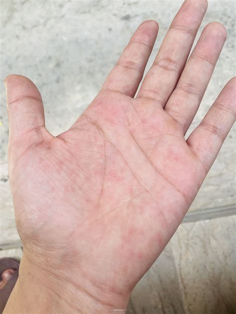 Ask A Dermatologist Online For Tiny Itchy Bumps On Palm