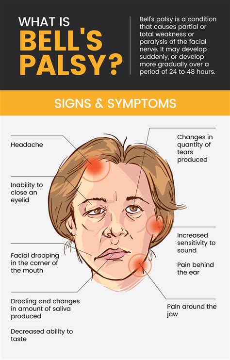 Bells Palsy Vs Stroke Bells Palsy And Burns Foamcast As Shown