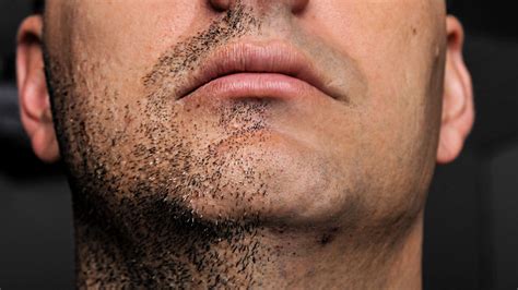 38 Hq Images Black Man Beard Ingrown Hair Ingrown Hair Disease
