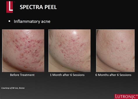 Hollywood Spectra Carbon Peel Surface Clinic