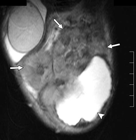 Mr Imaging Of The Testicular And Extratesticular Tumors 6c0