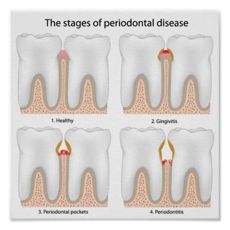 Tooth Periodontal Disease Poster Periodontitis