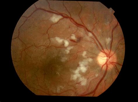 Right Eye Multiple Cotton Wool Spots And Retinal Haemorrhages Around