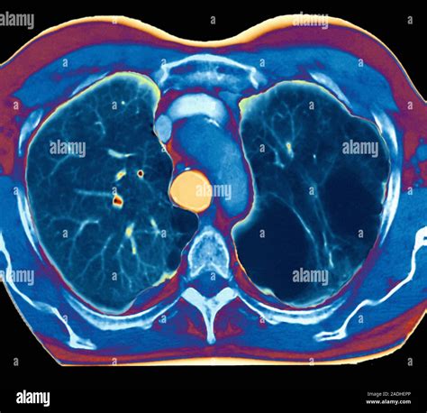 Emphysema Coloured Computed Tomography Ct Scan Of An Axial Section