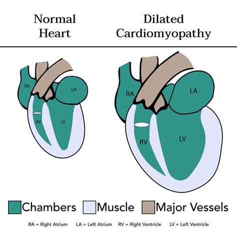 Palpitations And Alcoholic Cardiomyopathy Heart And Alcohol