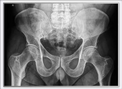 Eine achillessehnenruptur bedeutet einen abriss der achillessehne (tendo calcaneus achilles), die das. Hüfte | Privatklinik | Beta Klinik