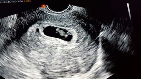 5 Weeks Pregnant Ultrasound 5 Weeks Pregnant On Tumblr 5 Weeks
