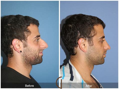 Male Rhinoplasty Newport Beach Nose Surgery Dr Sadati