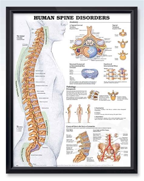Human Spine Disorders Exam Room Anatomy Posters Clinicalposters