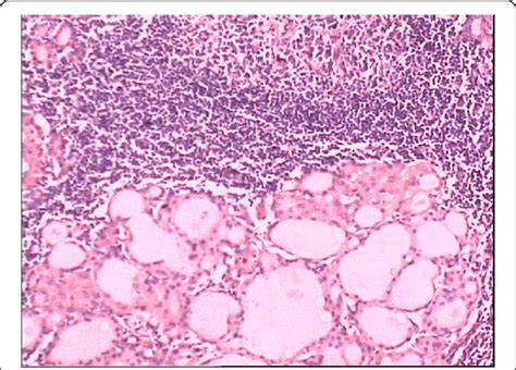 Atrophy Of Thyroid Gland Eosinophilic Change Of Epithelial Cells And