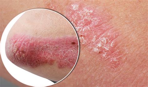 Psoriasis Sufferers Could Benefit From Foam Spray To Ease Condition