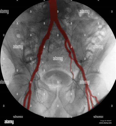 Angiogram Of Iliac Arteries Stock Photo Alamy