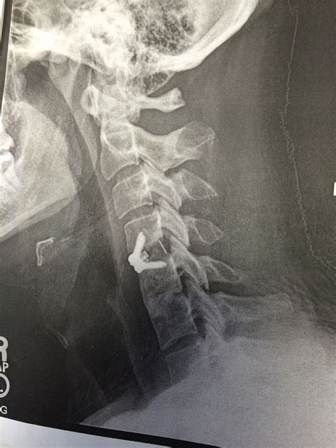 Recovery Timeline After Cervical Spine Surgery By Dr Arun Saroha
