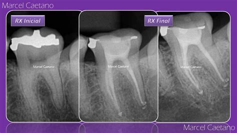 Endodontia Avançada Tratamento endodôntico de molar inferior com confecção imediata de núcleo