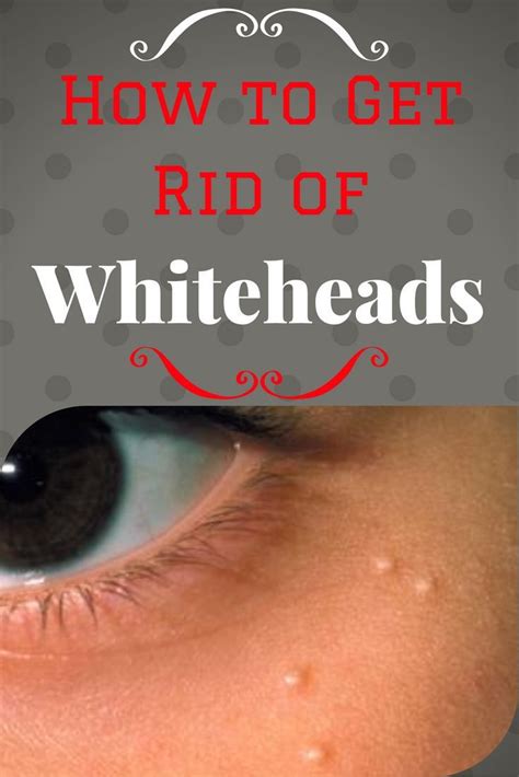 How To Get Rid Of Whiteheads By Skin Care Face Care