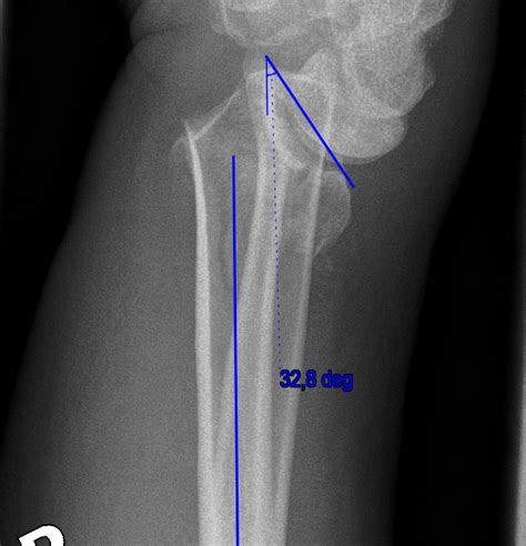 Fracture Osteotomy Distal Radius