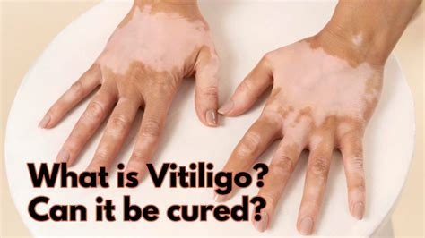 What Is Vitiligo Can It Be Cured Know Symptoms Signs To Detect