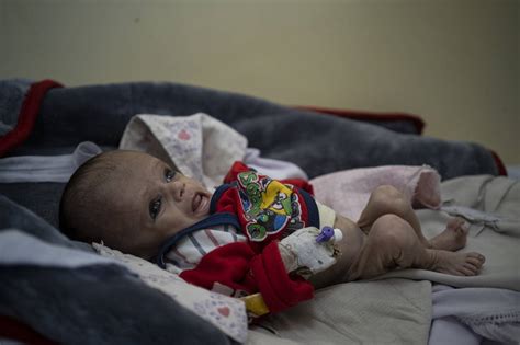Emaciated Children In Kabul Hospital Point To Rising Hunger