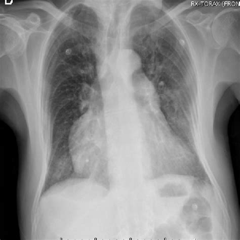 Chest Radiograph Signs Of Hyperinflation Lung Parenchymal Scarring