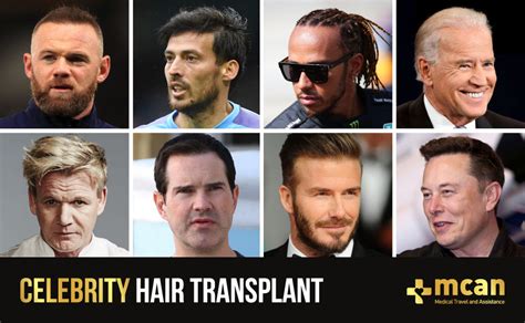 Top Celebrities Who Have Had Hair Transplants