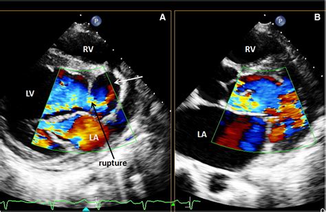 Echocardiographic Diagnosis Of Dissection Of Valsalva Sinus Into