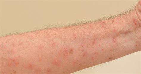 10 Home Remedies For Scabies Facty Health