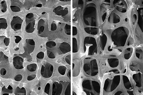 Osteoporosis And Metabolic Bone Disease Division Of Endocrinology